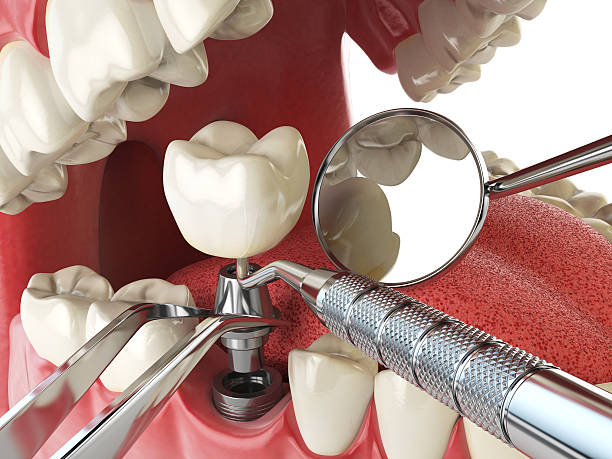 Best Emergency Root Canal Treatment in Ashland City, TN